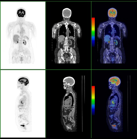 PET / CT Scan - Lake Medical Imaging - The Villages ... colon diagram 