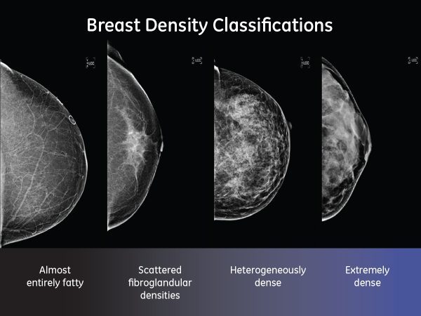 Imaging breast mammogram